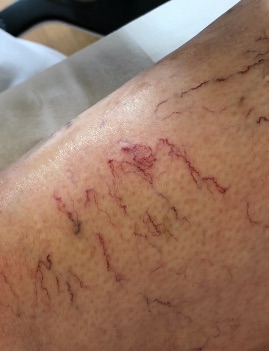 Besenreiser entfernen Uznach: Einfach Termin vereinbaren!