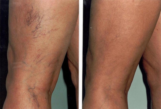 Besenreiser spritzen Freienbach: Einfach kostenlos anfragen!