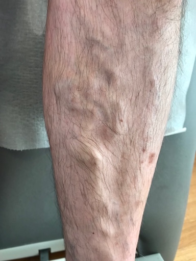 Varizen entfernen Zürich: Einfach kostenlos anfragen!