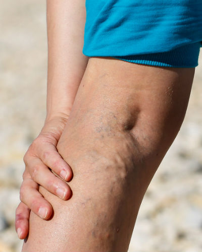 Krampfadern lasern oder ziehen: Stellen Sie eine unverbindliche Anfrage für einen Termin!