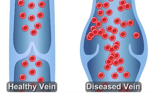 Behandlung von Krampfadern in den Beinen: Direkt unverbindlich anfragen!